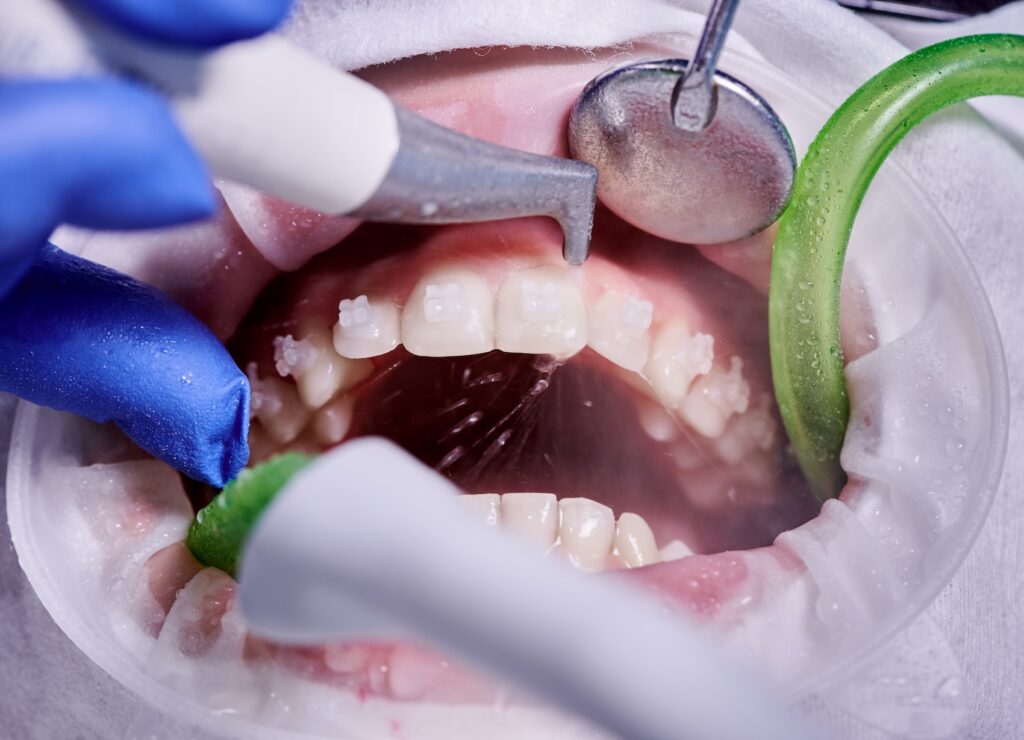 A patient receives a cleaning as treatment for diseased gums in Craven County