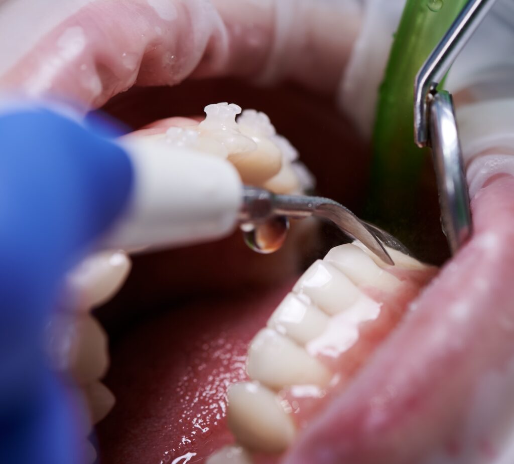 A close-up of a patient as they receive a cleaning for gingivitis treatment in Craven County