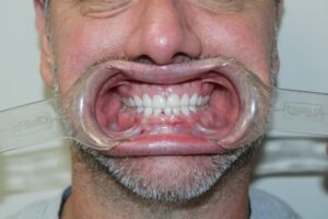 A patient's teeth after a smile makeover from a cosmetic dentist in Craven County. His teeth are now whitened, and healthy looking. 